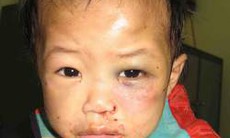 Lại thêm vụ hành hạ trẻ em dã man: Cháu bé bị rạch lưỡi lam lên người trong thời gian dài